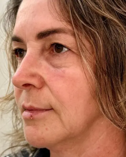 Antes: rosto de perfil
