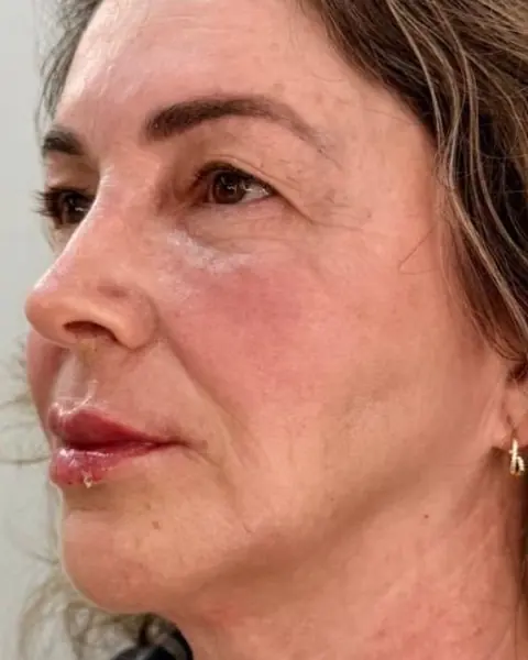 Depois: rosto de perfil após o HarmôFace