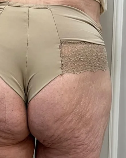 Antes: glúteos com assimetria e flacidez