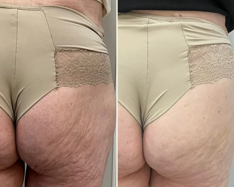 Antes e depois de bioestimulador nos glúteos