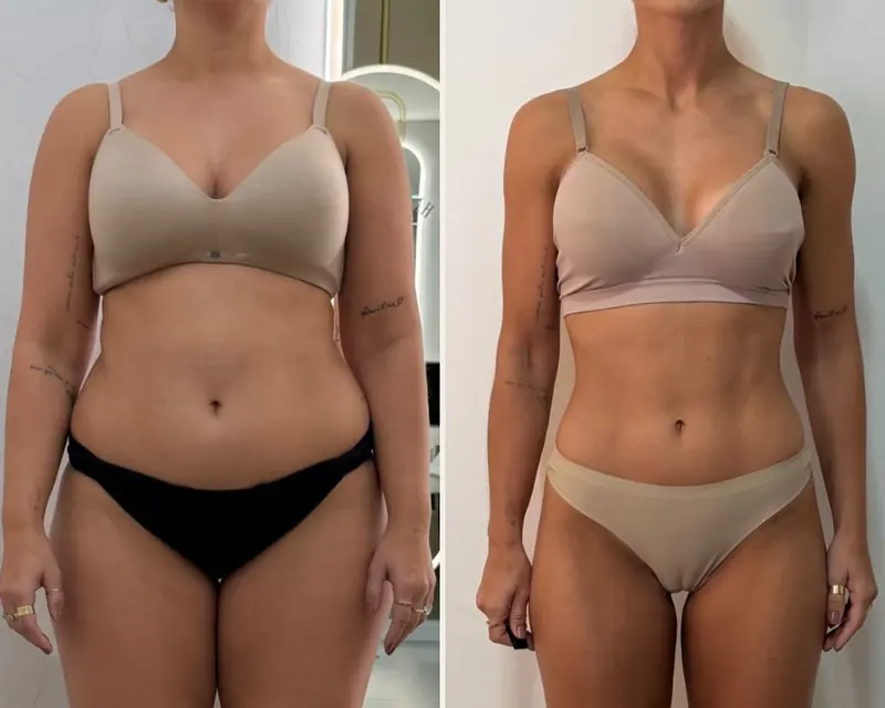 Antes e depois de um programa de emagrecimento